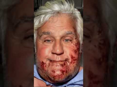 Jay Leno shows off his new ear after accident